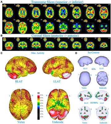 Increased Asymmetric Perfusion of the Cerebral Cortices and Thalamus Indicates Individuals at Risk for Bipolar Disorder: A Family Cohort Single Photon Emission Computed Tomography Neuroimaging Study